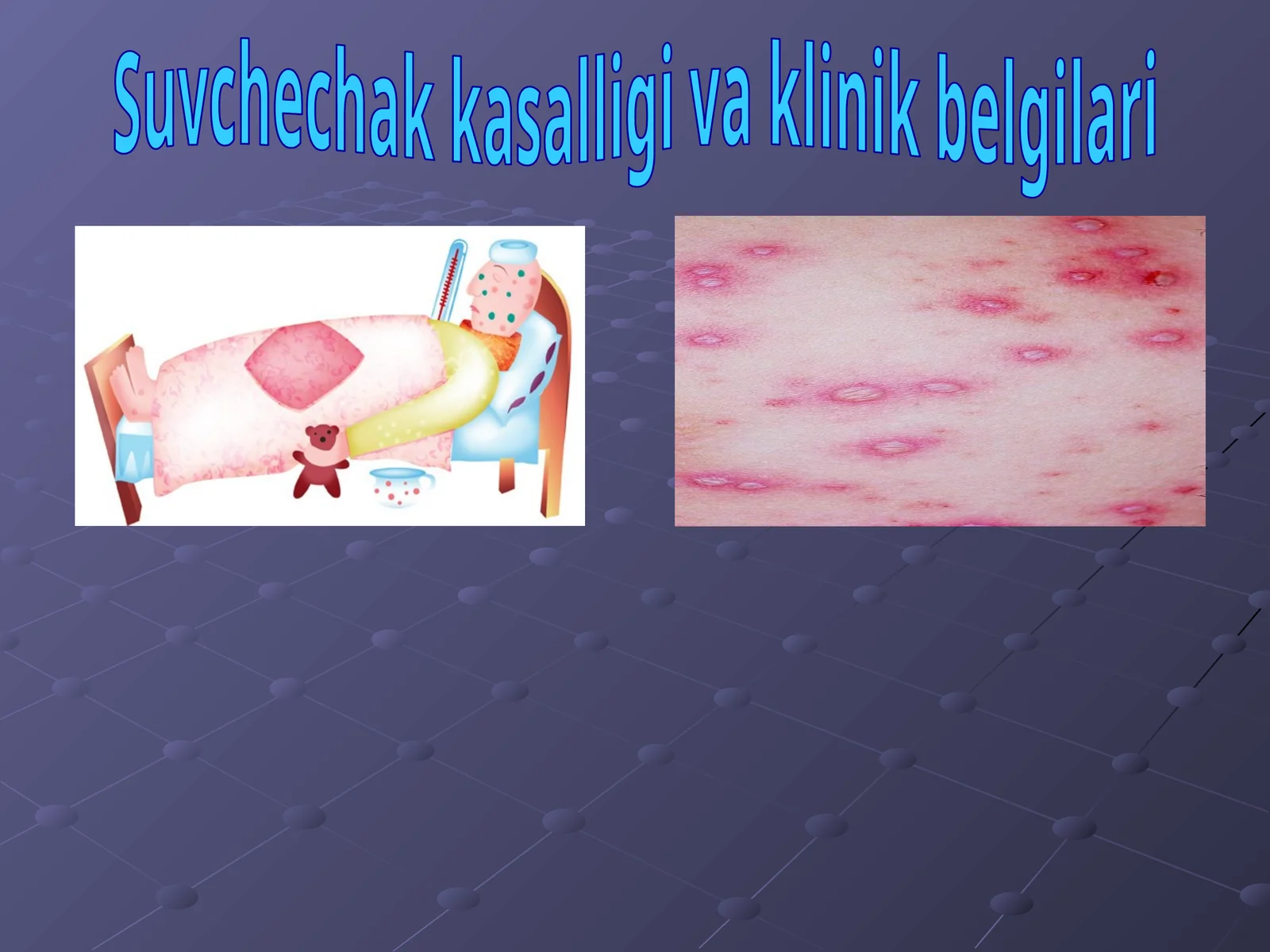 Suvchechak kasalligi va klinik belgilari